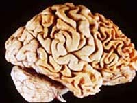 Brain damage from Alzheimer’s disease could potentially be reversed by HDAC inhibitors.