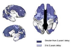 Parts of the brain that are slow to mature in ADHD children.